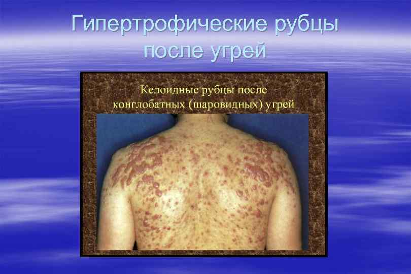 Гипертрофические рубцы после угрей 