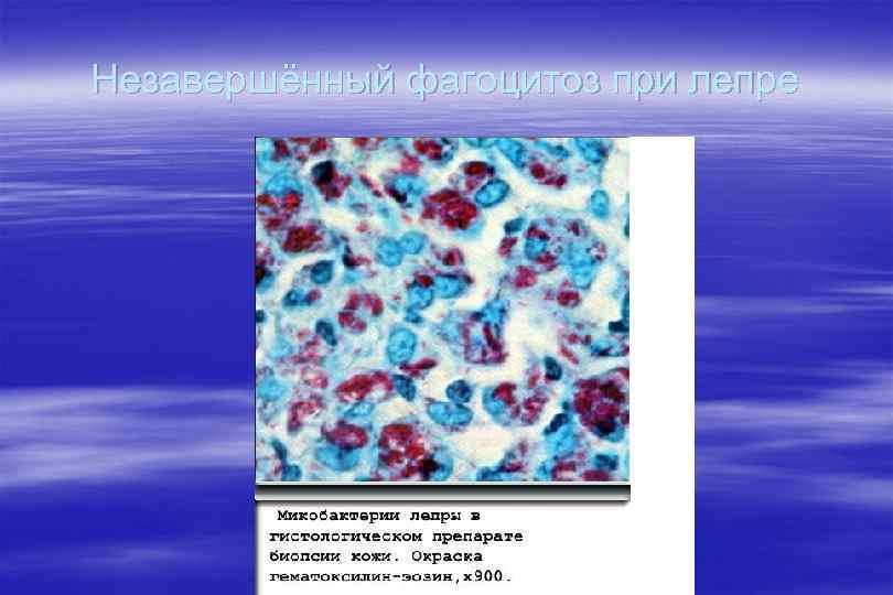 Незавершённый фагоцитоз при лепре 