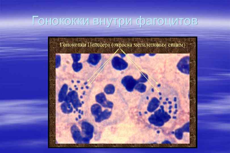 Гонококки внутри фагоцитов 
