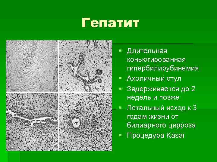 Ахоличный стул при вирусных гепатитах