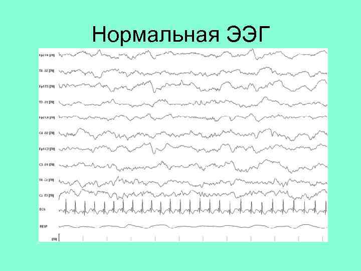 Нормальная ЭЭГ 