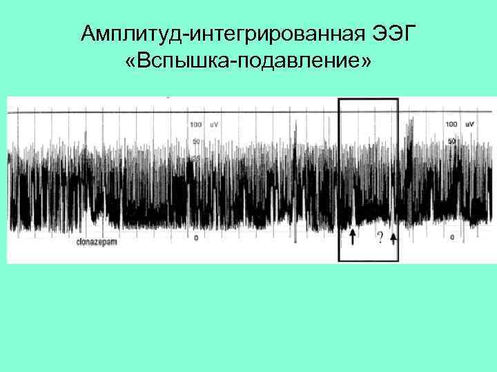 Амплитуд-интегрированная ЭЭГ «Вспышка-подавление» 