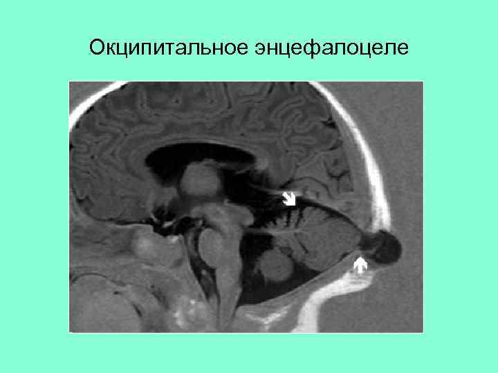 Окципитальное энцефалоцеле 