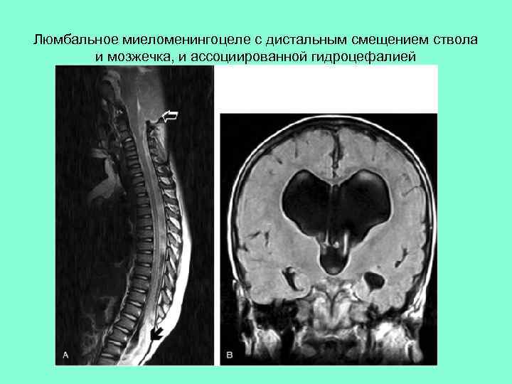 Люмбальное миеломенингоцеле с дистальным смещением ствола и мозжечка, и ассоциированной гидроцефалией 