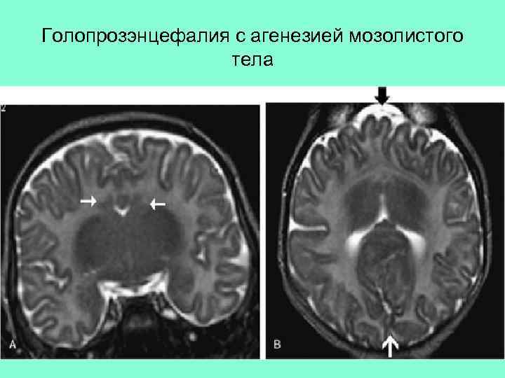 Голопрозэнцефалия с агенезией мозолистого тела 