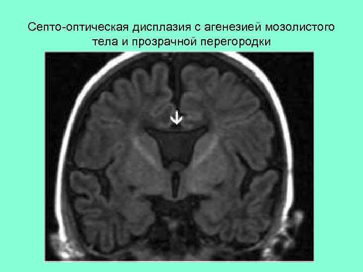 Септо-оптическая дисплазия с агенезией мозолистого тела и прозрачной перегородки 