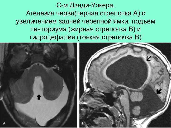 С-м Дэнди-Уокера. Агенезия червя(черная стрелочка А) с увеличением задней черепной ямки, подъем тенториума (жирная