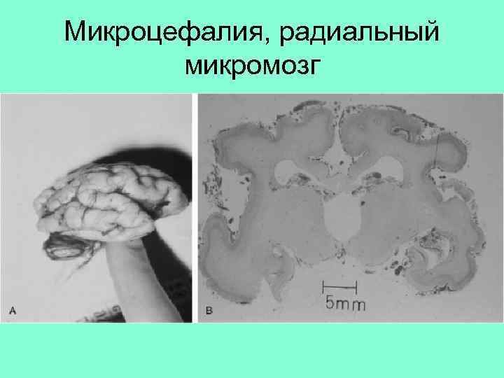 Микроцефалия, радиальный микромозг 
