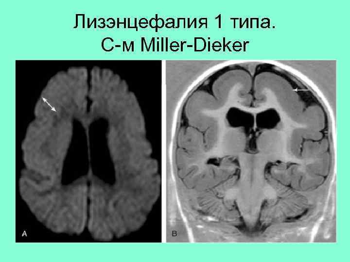 Лизэнцефалия 1 типа. С-м Miller-Dieker 