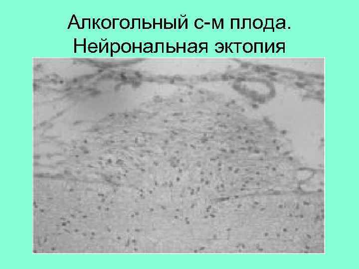 Алкогольный с-м плода. Нейрональная эктопия 