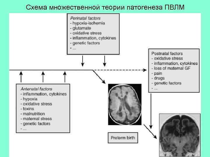 Схема множественной теории патогенеза ПВЛМ 