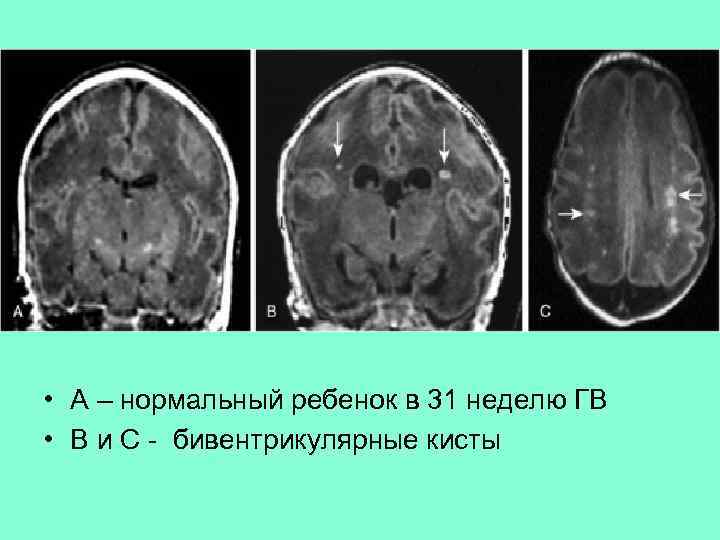  • А – нормальный ребенок в 31 неделю ГВ • В и С