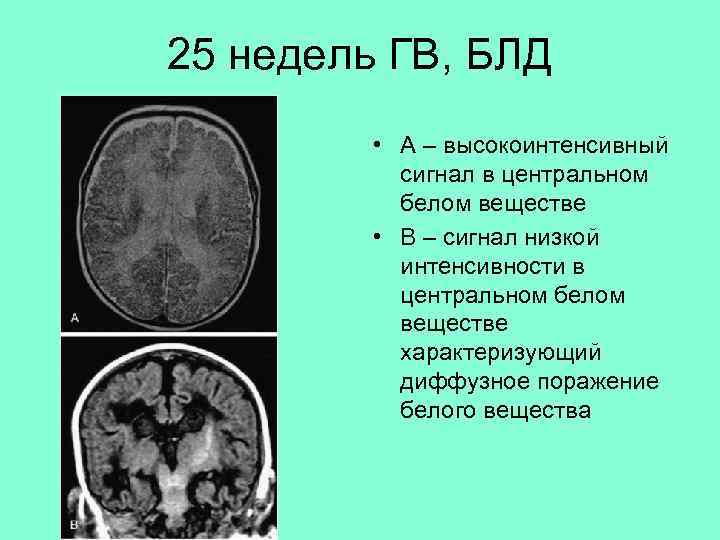 25 недель ГВ, БЛД • А – высокоинтенсивный сигнал в центральном белом веществе •