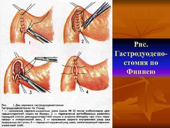 Рис. Гастродуоденостомия по Финнею 