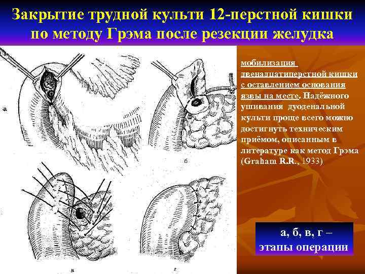 Закрытие трудной культи 12 -перстной кишки по методу Грэма после резекции желудка мобилизация двенадцатиперстной