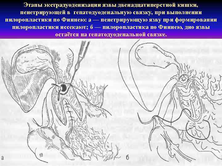 Этапы экстрадуоденизации язвы двенадцатиперстной кишки, пенетрирующей в гепатодуоденальную связку, при выполнении пилоропластики по Финнею: