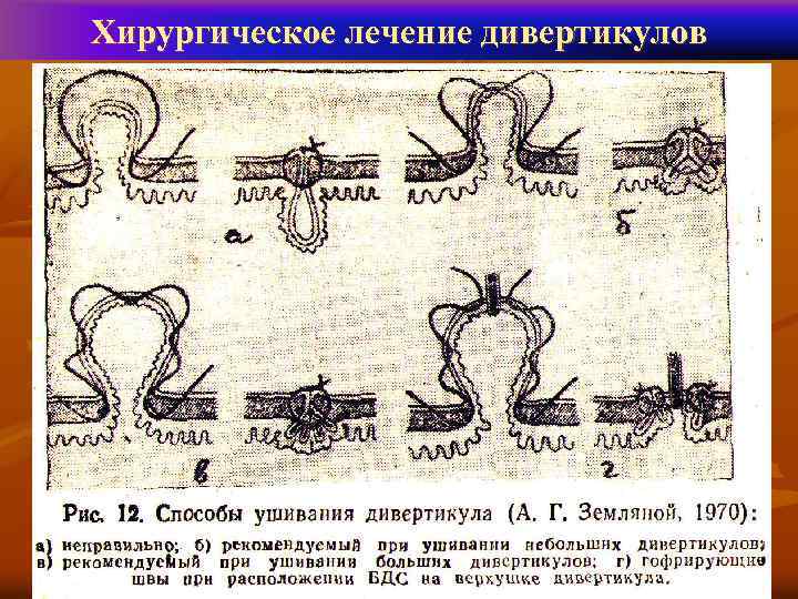 Хирургическое лечение дивертикулов 