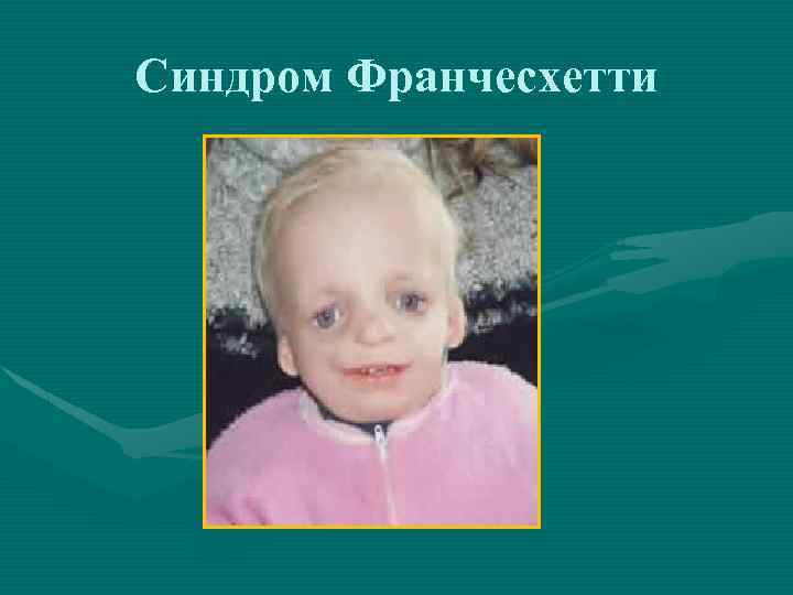 Синдром Франчесхетти 