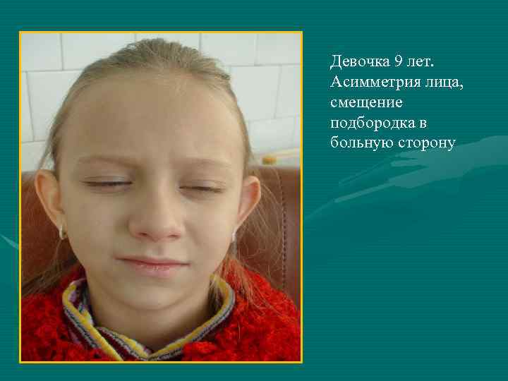 Девочка 9 лет. Асимметрия лица, смещение подбородка в больную сторону 