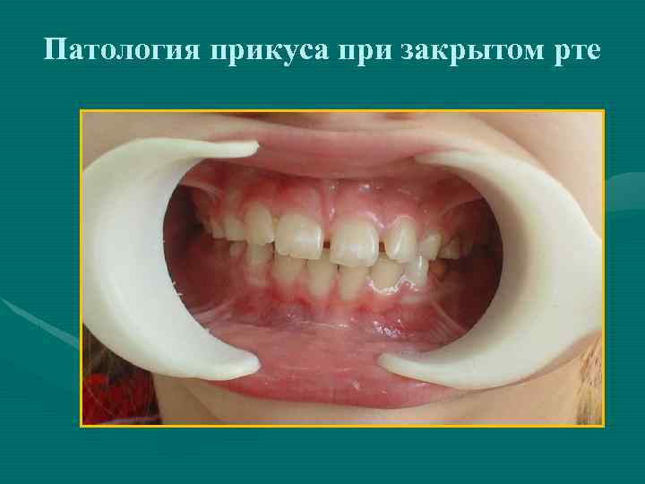 Патология прикуса при закрытом рте 