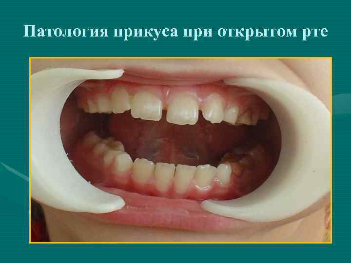 Патология прикуса при открытом рте 