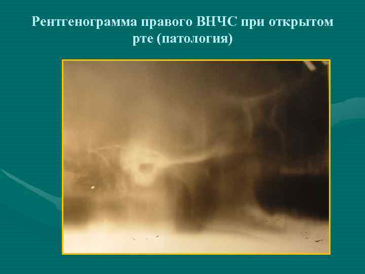 Рентгенограмма правого ВНЧС при открытом рте (патология) 