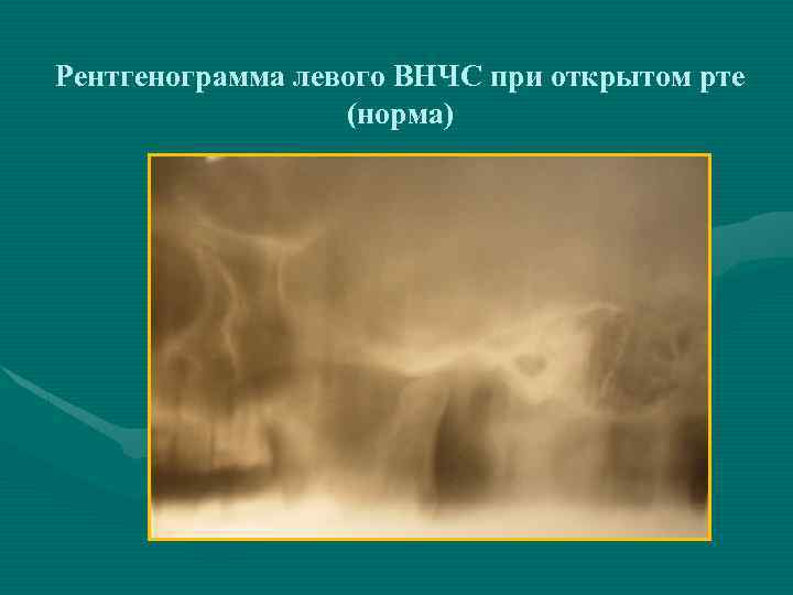 Рентгенограмма левого ВНЧС при открытом рте (норма) 