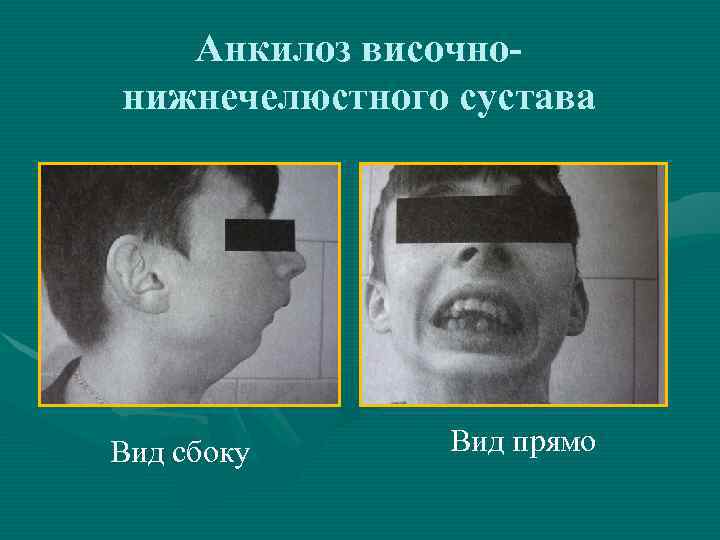 Анкилоз височнонижнечелюстного сустава Вид сбоку Вид прямо 