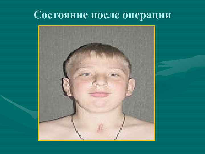 Состояние после операции 