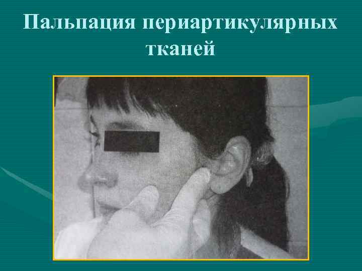 Пальпация периартикулярных тканей 