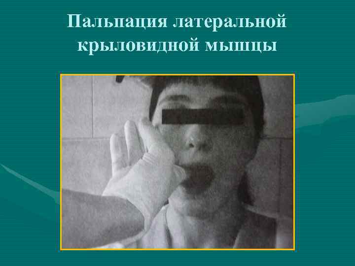 Пальпация латеральной крыловидной мышцы 