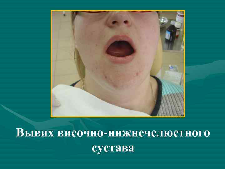 Вывих височно-нижнечелюстного сустава 