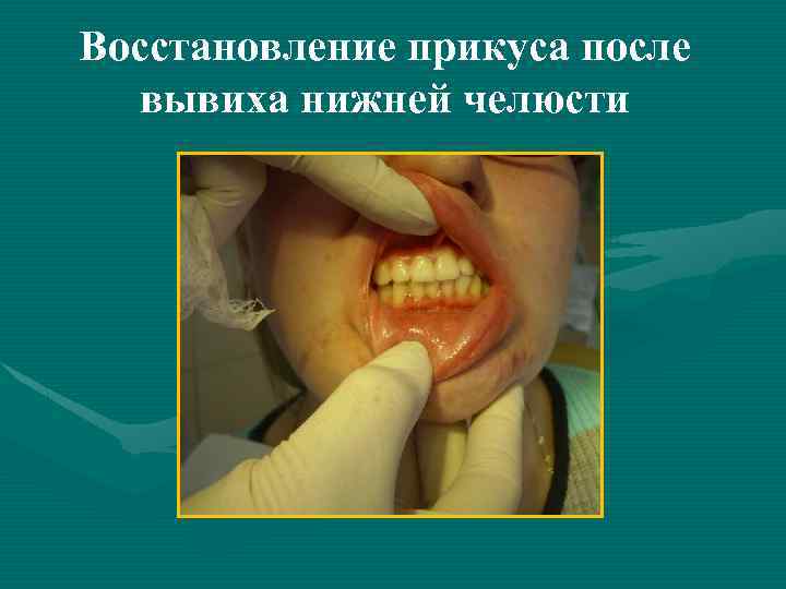 Восстановление прикуса после вывиха нижней челюсти 
