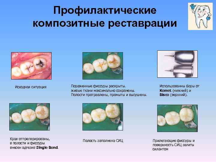Профилактические композитные реставрации Исходная ситуация Края отпрепарированы, в полости и фиссуры внесен адгезив Single
