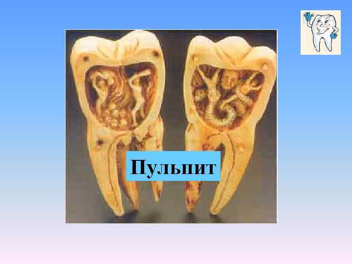 Пульпит 