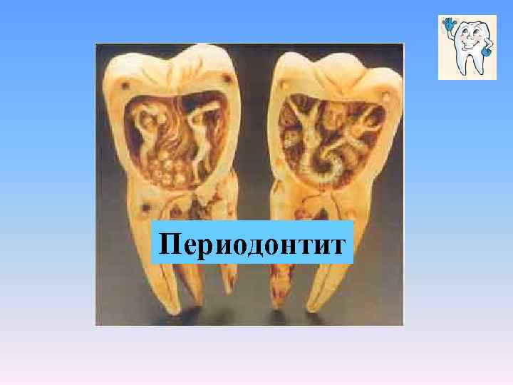 Периодонтит 