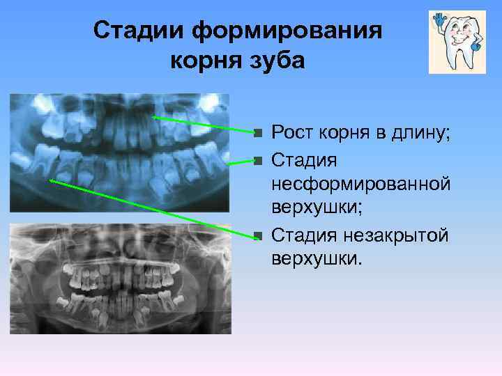 Стадии формирования корня зуба n n n Рост корня в длину; Стадия несформированной верхушки;