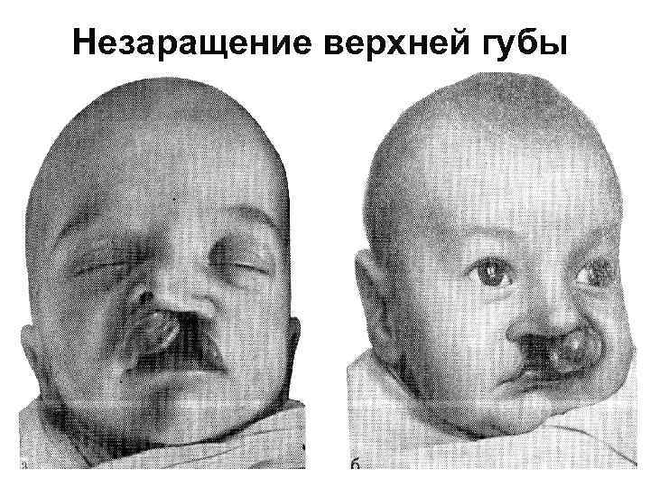 Незаращение верхней губы 