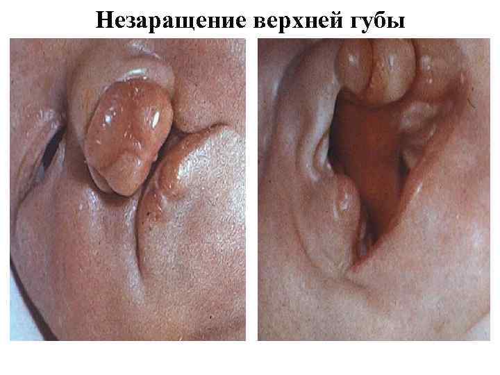 Незаращение верхней губы 