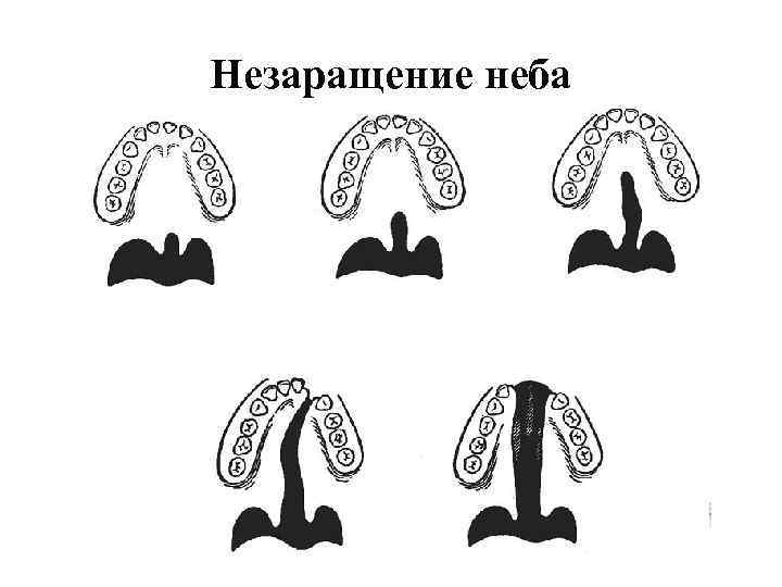 Незаращение неба 