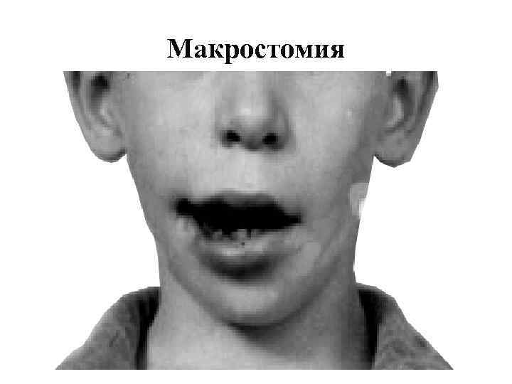 Макростомия 