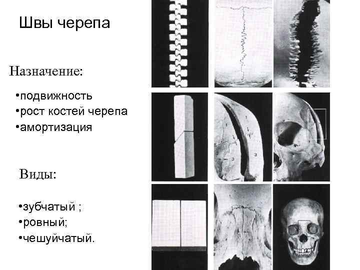 Швы черепа Назначение: • подвижность • рост костей черепа • амортизация Виды: • зубчатый