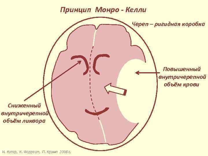 Принцип Монро - Келли Череп – ригидная коробка Повышенный внутричерепной объём крови Сниженный внутричерепной
