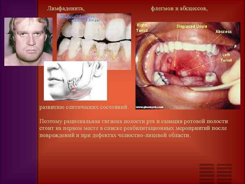  Лимфаденита, флегмон и абсцессов, развитию септических состояний. Поэтому рациональная гигиена полости рта и