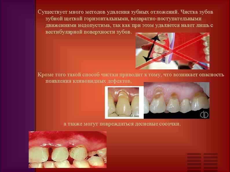 Существует много методов удаления зубных отложений. Чистка зубов зубной щеткой горизонтальными, возвратно-поступательными движениями недопустима,