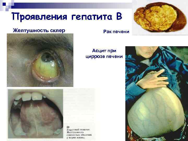 Проявления гепатита В Желтушность склер Рак печени Асцит при циррозе печени 