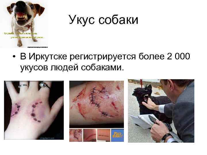 Укус собаки • В Иркутске регистрируется более 2 000 укусов людей собаками. 