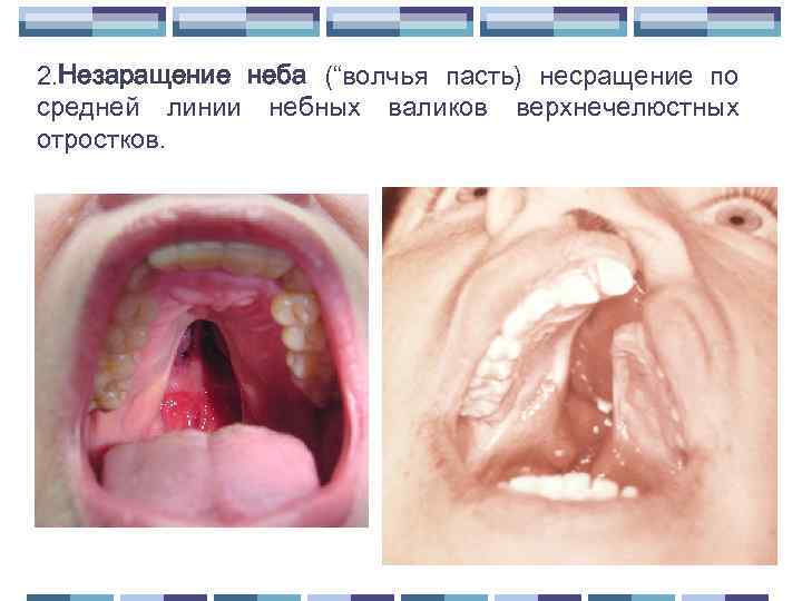 2. Незаращение неба (“волчья пасть) несращение по средней линии небных валиков верхнечелюстных отростков. 