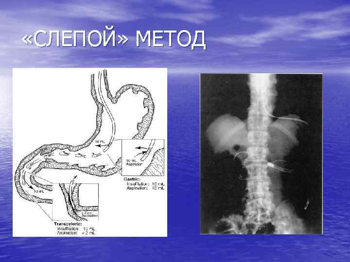  «СЛЕПОЙ» МЕТОД 