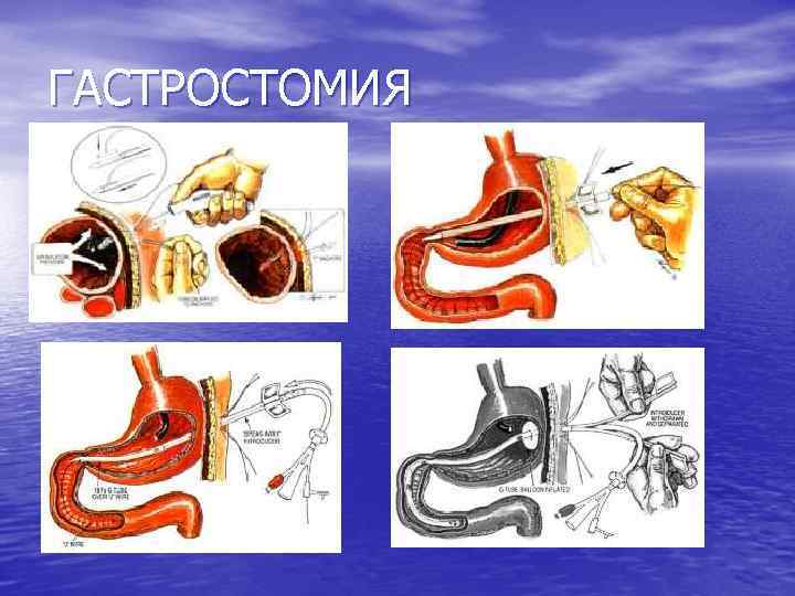 ГАСТРОСТОМИЯ 